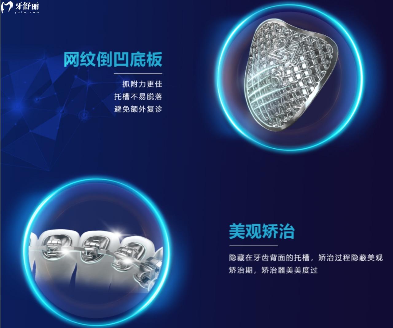 易美正畸個性化舌側(cè)自鎖矯治器