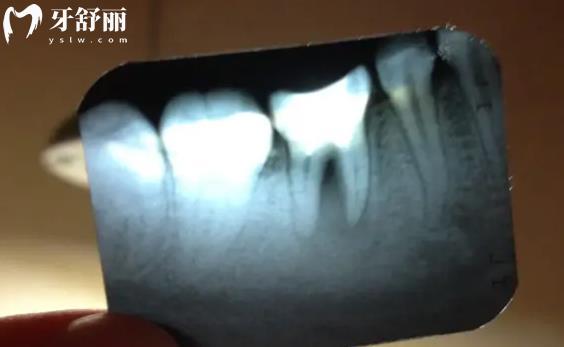 看牙前的檢查太費(fèi)錢了有必要做嗎 其實(shí)這些牙科項(xiàng)目不用拍片