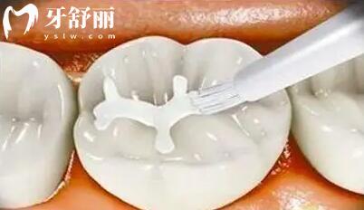 請問孩子牙齒已經被齲齒還能窩溝封閉嗎？.jpg