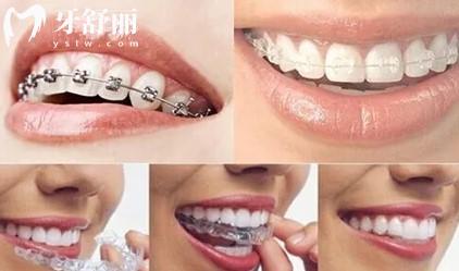 牙齒矯正器