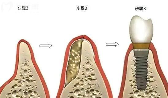 牙科醫(yī)生告知我種牙前需“植骨”,種牙需要植骨是怎么回事?.jpg