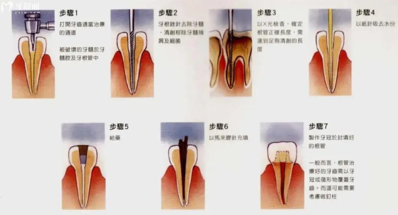 根管治療過(guò)程