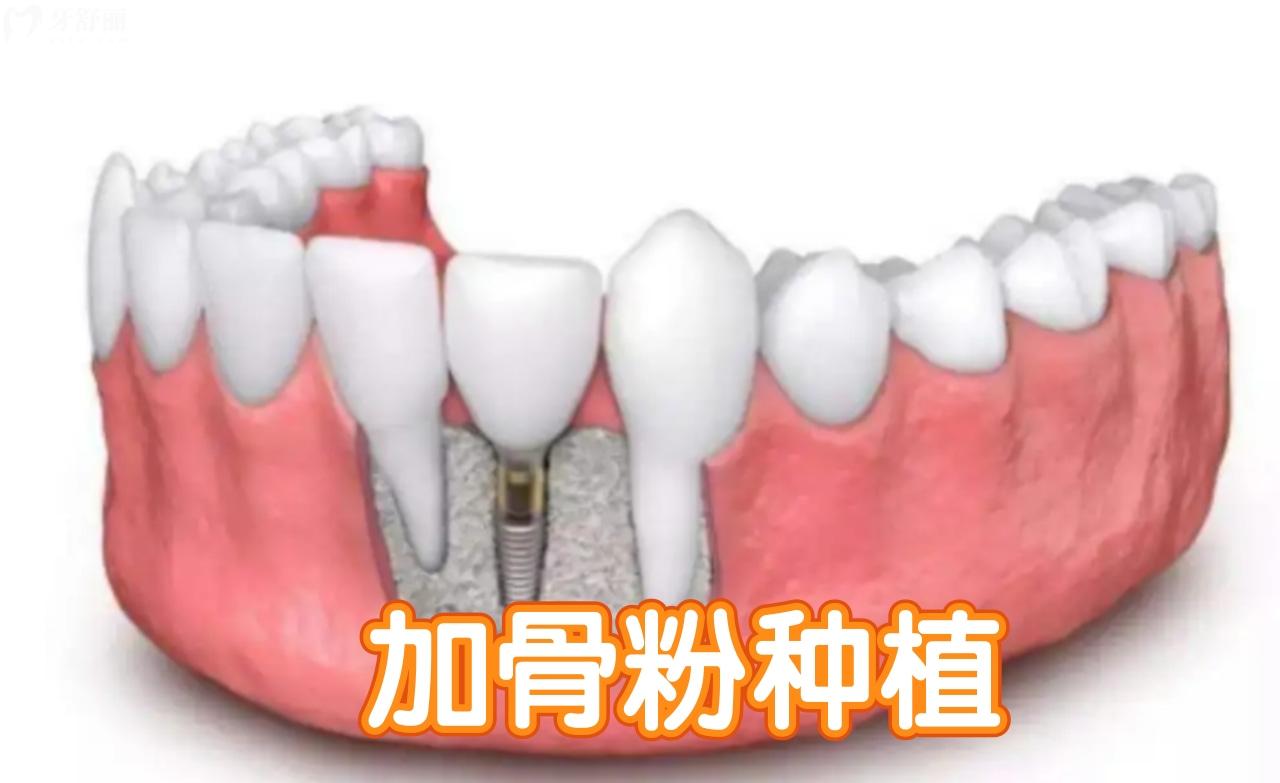 骨量不足需要做骨增量種植