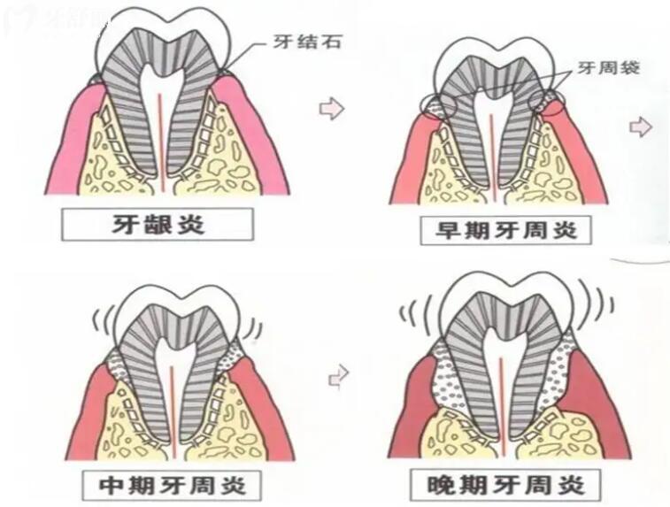 牙周炎能治好嗎？
