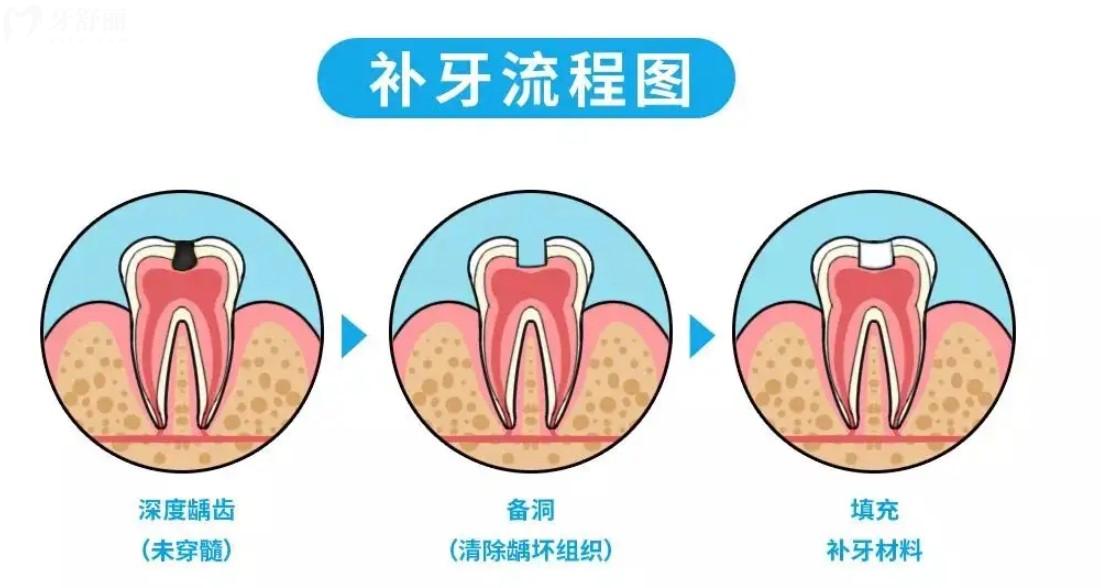 補牙過程圖