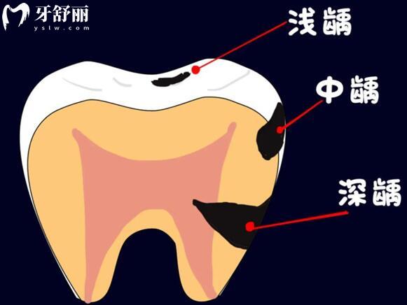 牙齒上面有黑線是什么原因造成的?該怎么治療？.jpg