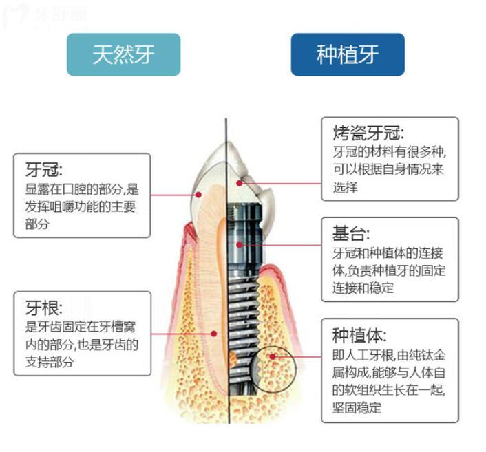 重慶種植牙集采價格是真的實(shí)在降了嗎？可能要打七折