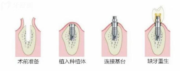 普通種植牙