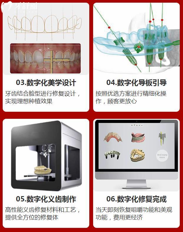 中諾口腔數(shù)字化種植步驟