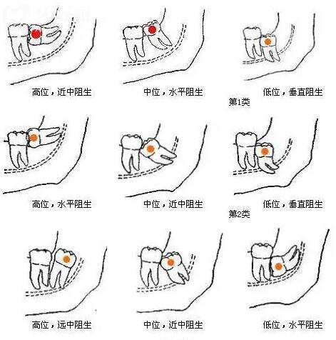 請問智齒一定要拔嗎一定要拔嗎?拔智齒后多久可以正常?.jpg