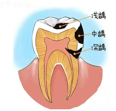 牙齒上黑洞的真相 探究牙上黑洞里面到底有什么看圖片