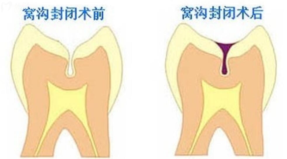 窩溝封閉幾歲做比較適合
