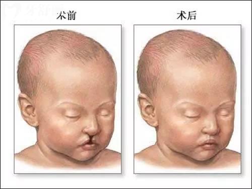 腭裂手術(shù)后什么時候什么東西都能吃?你不要亂來啊!