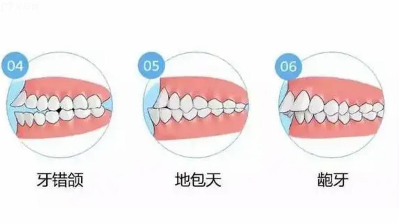 中山正畸哪個醫(yī)院好?附上正畸醫(yī)院評價和地址!