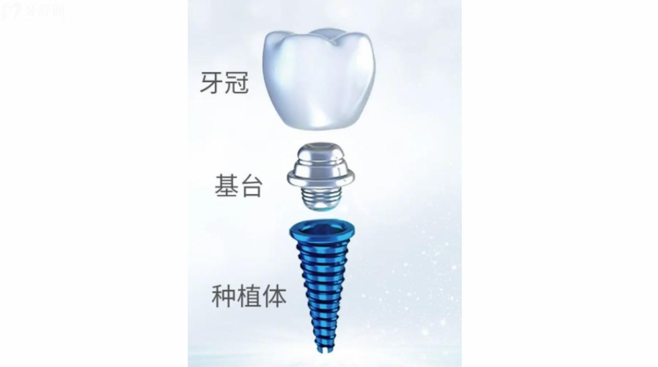 韓國種植牙品牌有哪些?價格和優(yōu)勢是什么?