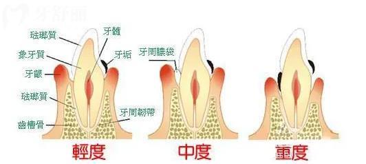 4黃石牙科收費價目表 一般拔牙 補牙 種牙 整牙多少錢？
