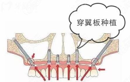 穿顴穿翼種植牙手術風險大嗎？技術已將成熟了嗎？
