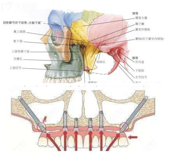 穿顴穿翼種植牙手術風險大嗎？技術已將成熟了嗎？