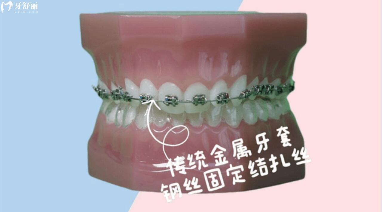 自鎖牙套和普通牙套有什么區(qū)別弊端在哪里？一起來了解下