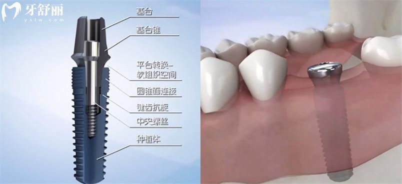 種植牙多少錢一顆2023年新版收費(fèi)標(biāo)準(zhǔn)公布