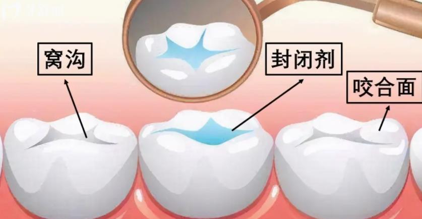 家長(zhǎng)注意啦！孩子這顆牙一生不會(huì)換現(xiàn)在保護(hù)來(lái)得及