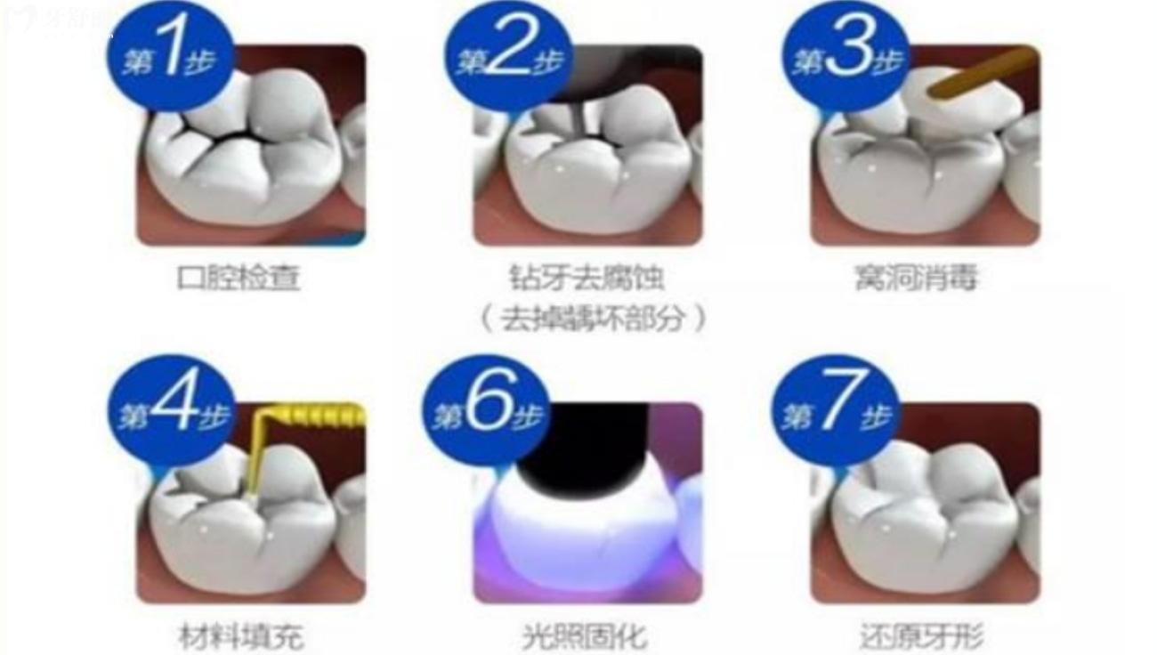 美國科爾Kerr樹脂補牙怎么樣.jpg