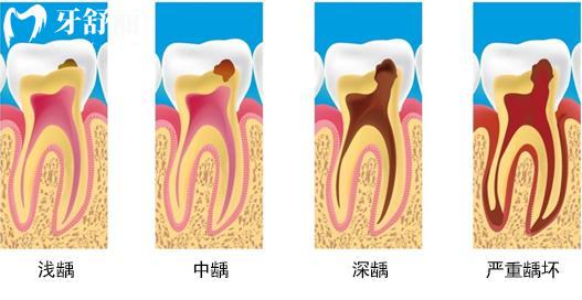 發(fā)起病來難以入眠的牙疼為什么總在深夜開始？
