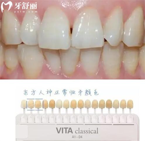 為什么每天認(rèn)真刷牙牙齒還不會(huì)變白？有什么解決辦法？
