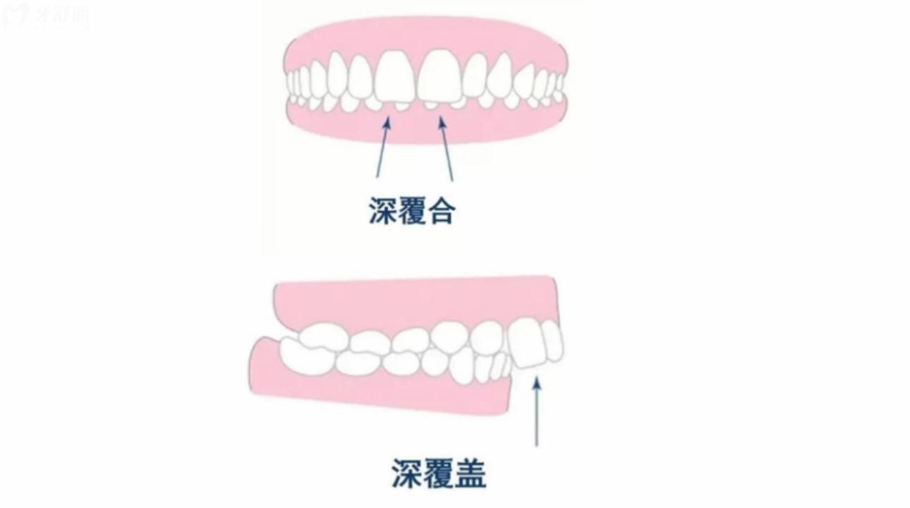 深覆合做矯正多少錢(qián)?深覆合矯正的年齡？
