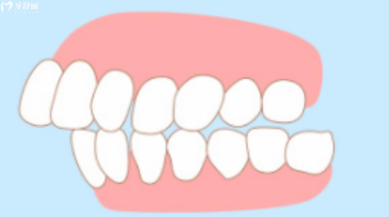 深覆合做矯正多少錢(qián)?深覆合矯正的年齡？