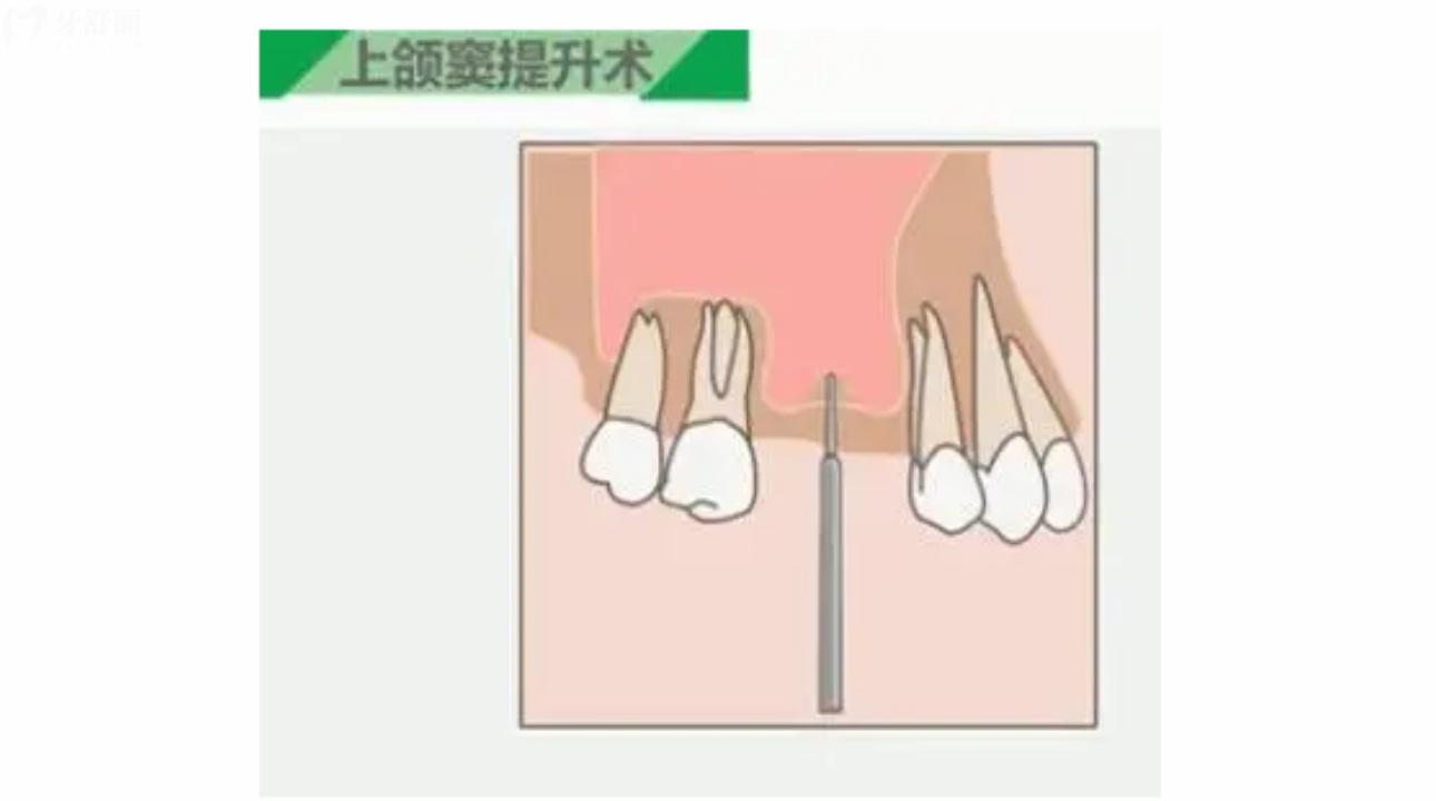 上頜竇提升種植術(shù)