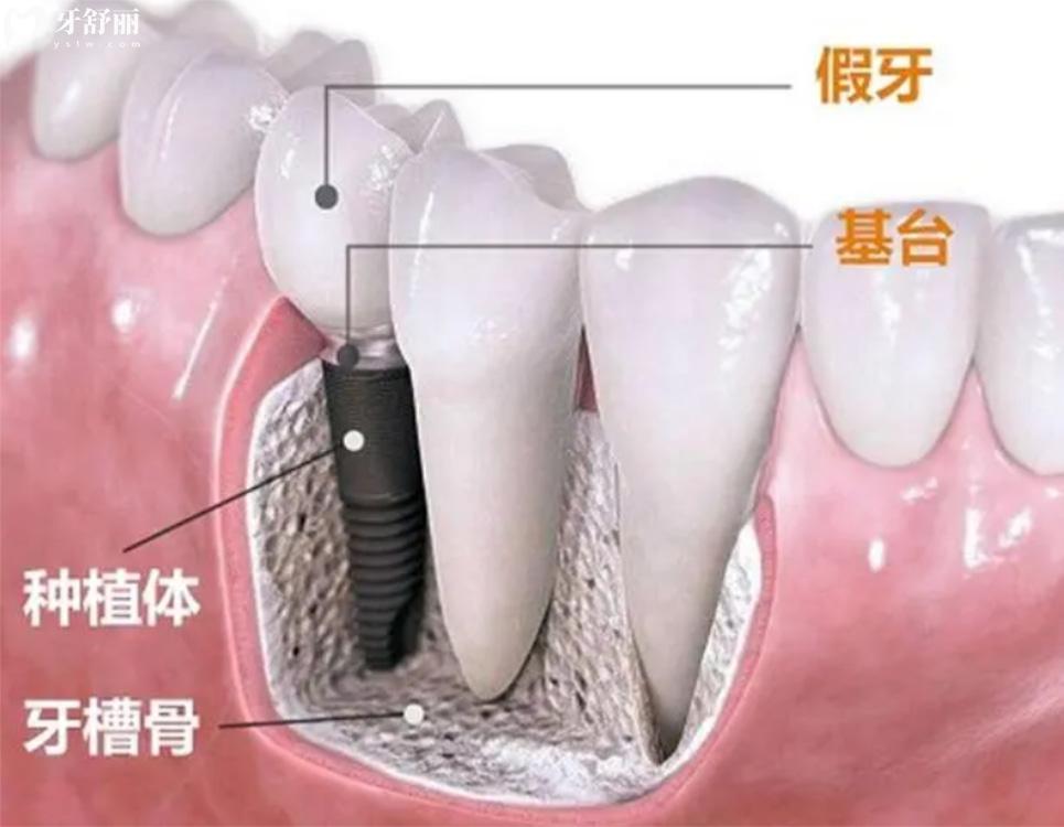 孝感種植牙多少錢一顆.jpg