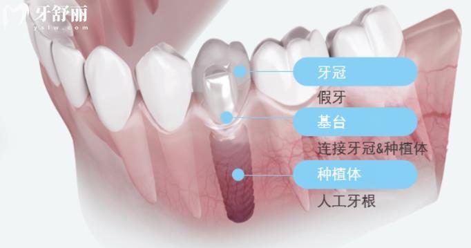 玉林口腔醫(yī)院價目表 玉林種植牙多少錢 玉林牙齒矯正費(fèi)用 玉林補(bǔ)牙多少錢