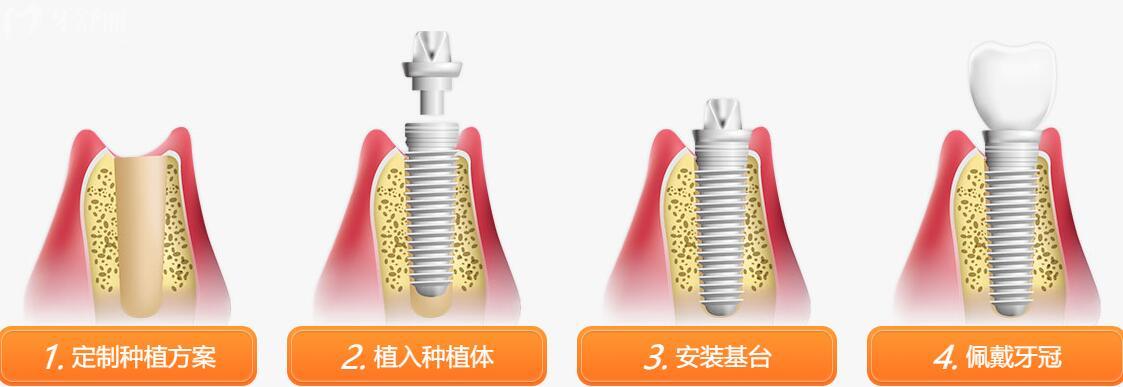 瑞典N(xiāo)obel諾貝爾種植牙怎么樣