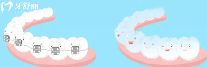 牙齒矯正免費，牙齒矯正器的種類及價格