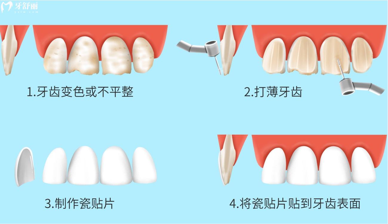 門牙從側(cè)面掉了一半能補(bǔ)上嗎.jpg