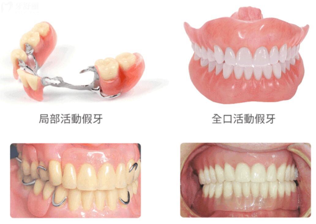 假牙用什么材料好?價格有啥不同?應(yīng)該怎么選擇才性價高