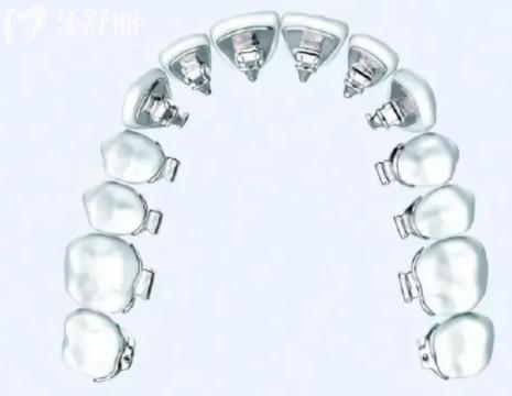 廣州牙齒矯正多少錢價(jià)格表2023