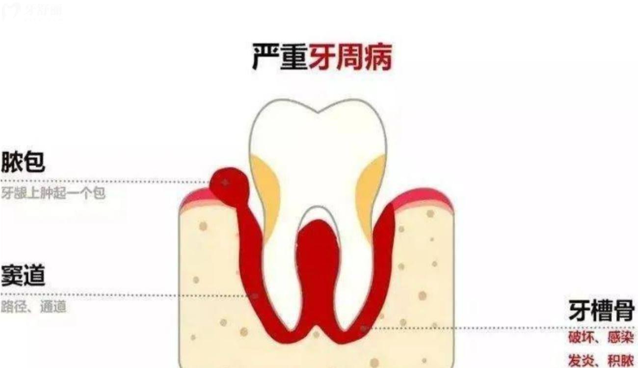 牙齒得了牙周炎怎么辦.jpg