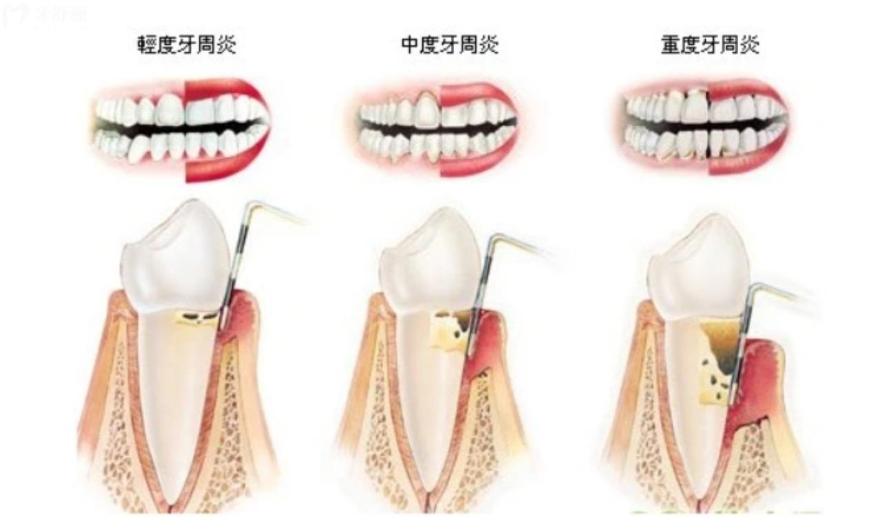牙齒得了牙周炎怎么辦.jpg