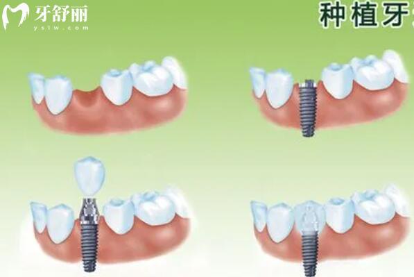 上海徐匯區(qū)滿口種植牙多少錢?集采后全口/半口/單顆費(fèi)用