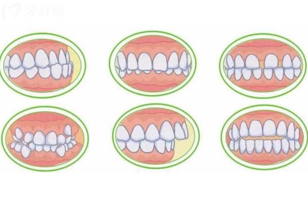 牙齒不齊各種表現(xiàn).jpg