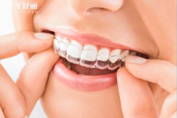 隱形矯正牙套美觀(guān)舒適
