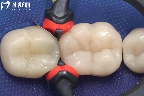 杭州上塘口腔醫(yī)院補(bǔ)牙
