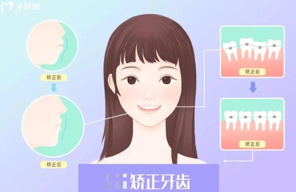牙齒矯正