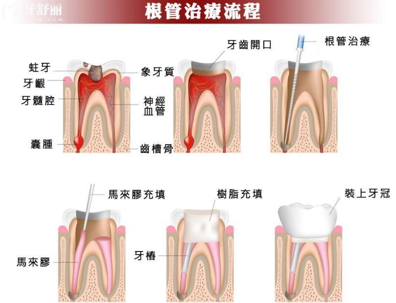 根管治療后不戴牙冠，會出現(xiàn)什么情況？