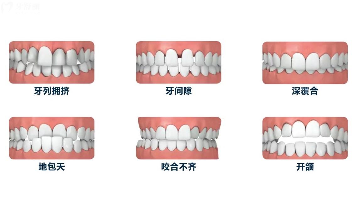 哪些情況需要做牙齒矯正