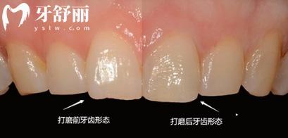廈門瓷貼面牙齒多少錢一顆