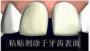 廈門牙齒貼面哪家醫(yī)院好