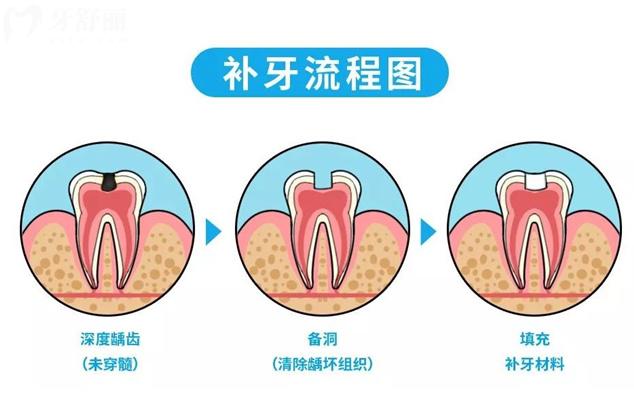 補(bǔ)牙過程